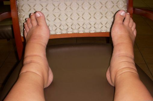 Legs Swelling